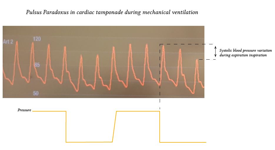 Cardiac tamponade Deranged Physiology